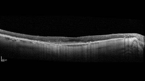 wet AMD with classic extrafoveal macular neovascularization in the good eye
89 year old man with longstanding vision loss in the left eye presented with one month of mild vision loss in the right eye.  Vision was 20/32.  This eye responded to vabysmo therapy.
