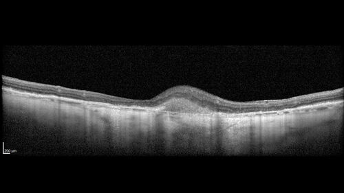 wet AMD with classic extrafoveal macular neovascularization in the good eye
89 year old man with longstanding vision loss in the left eye presented with one month of mild vision loss in the right eye.  Vision was 20/32.  This eye responded to vabysmo therapy.
