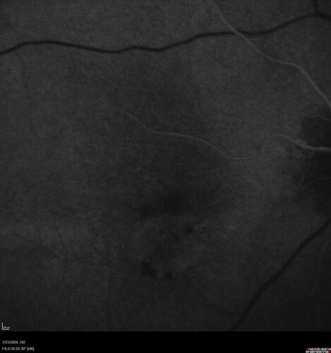 wet AMD with classic extrafoveal macular neovascularization in the good eye
89 year old man with longstanding vision loss in the left eye presented with one month of mild vision loss in the right eye.  Vision was 20/32.  This eye responded to vabysmo therapy.
