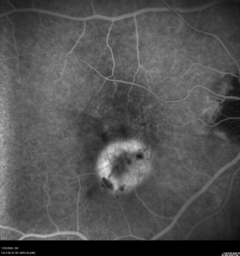 wet AMD with classic extrafoveal macular neovascularization in the good eye
89 year old man with longstanding vision loss in the left eye presented with one month of mild vision loss in the right eye.  Vision was 20/32.  This eye responded to vabysmo therapy.
