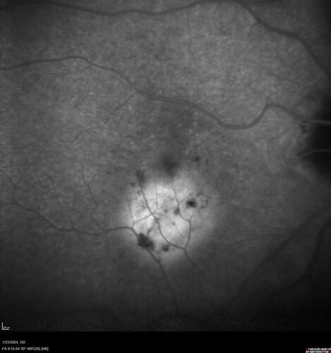wet AMD with classic extrafoveal macular neovascularization in the good eye
89 year old man with longstanding vision loss in the left eye presented with one month of mild vision loss in the right eye.  Vision was 20/32.  This eye responded to vabysmo therapy.
