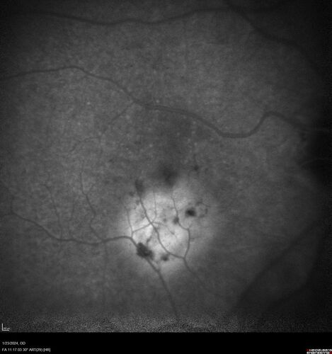 wet AMD with classic extrafoveal macular neovascularization in the good eye
89 year old man with longstanding vision loss in the left eye presented with one month of mild vision loss in the right eye.  Vision was 20/32.  This eye responded to vabysmo therapy.
