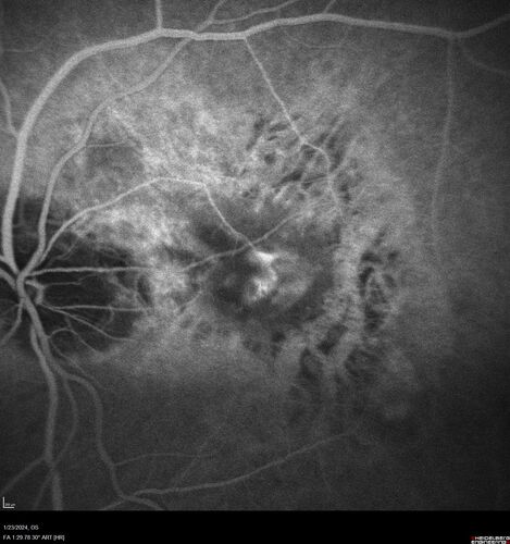 wet AMD with classic extrafoveal macular neovascularization in the good eye
89 year old man with longstanding vision loss in the left eye presented with one month of mild vision loss in the right eye.  Vision was 20/32.  This eye responded to vabysmo therapy.
