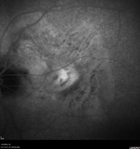 wet AMD with classic extrafoveal macular neovascularization in the good eye
89 year old man with longstanding vision loss in the left eye presented with one month of mild vision loss in the right eye.  Vision was 20/32.  This eye responded to vabysmo therapy.
