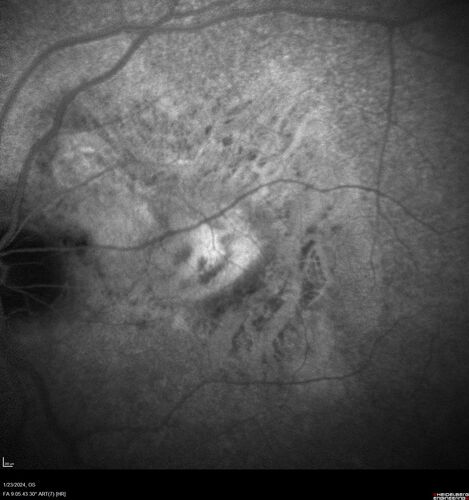 wet AMD with classic extrafoveal macular neovascularization in the good eye
89 year old man with longstanding vision loss in the left eye presented with one month of mild vision loss in the right eye.  Vision was 20/32.  This eye responded to vabysmo therapy.
