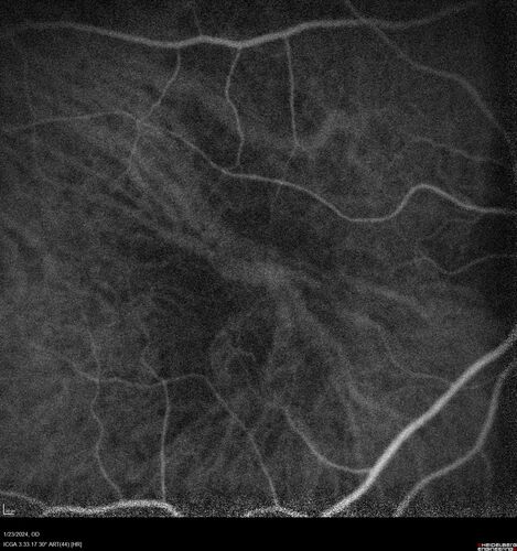 wet AMD with classic extrafoveal macular neovascularization in the good eye
89 year old man with longstanding vision loss in the left eye presented with one month of mild vision loss in the right eye.  Vision was 20/32.  This eye responded to vabysmo therapy.
