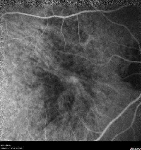 wet AMD with classic extrafoveal macular neovascularization in the good eye
89 year old man with longstanding vision loss in the left eye presented with one month of mild vision loss in the right eye.  Vision was 20/32.  This eye responded to vabysmo therapy.

