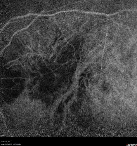 wet AMD with classic extrafoveal macular neovascularization in the good eye
89 year old man with longstanding vision loss in the left eye presented with one month of mild vision loss in the right eye.  Vision was 20/32.  This eye responded to vabysmo therapy.
