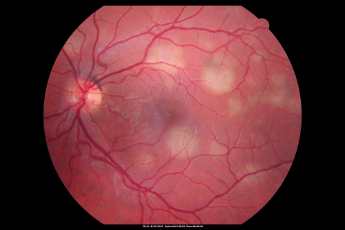 Acute Posterior Multifocal Placoid Pigment Epitheliopathy - APMPPE - Fundus Photo - Color
 25-year-old man with one and half weeks ago he woke up with night chills.   Also around that time his joints started hurting him.  He also has headaches, although the headache at this point is not severe.  His vision has been changing for about the last week and a half.  He sees some spots in his vision and they are blurred spots.  They are not in the central vision.  
VISUAL ACUITY:  OD 20/32,  OS 20/32
