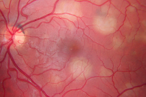 Acute Posterior Multifocal Placoid Pigment Epitheliopathy - APMPPE - Fundus Photo - Color
 25-year-old man with one and half weeks ago he woke up with night chills.   Also around that time his joints started hurting him.  He also has headaches, although the headache at this point is not severe.  His vision has been changing for about the last week and a half.  He sees some spots in his vision and they are blurred spots.  They are not in the central vision.  
VISUAL ACUITY:  OD 20/32,  OS 20/32
