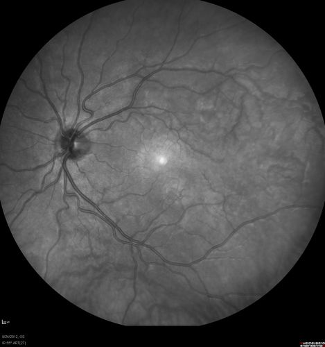 Acute Posterior Multifocal Placoid Pigment Epitheliopathy - APMPPE - InfraRed Photo
 25-year-old man with one and half weeks ago he woke up with night chills.   Also around that time his joints started hurting him.  He also has headaches, although the headache at this point is not severe.  His vision has been changing for about the last week and a half.  He sees some spots in his vision and they are blurred spots.  They are not in the central vision.  
VISUAL ACUITY:  OD 20/32,  OS 20/32
