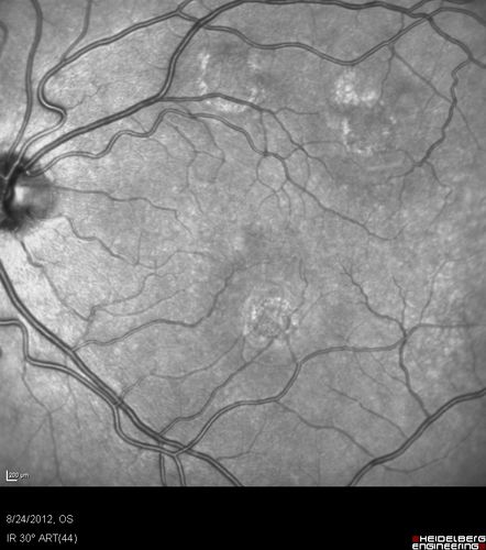 Acute Posterior Multifocal Placoid Pigment Epitheliopathy - APMPPE - InfraRed Photo
 25-year-old man with one and half weeks ago he woke up with night chills.   Also around that time his joints started hurting him.  He also has headaches, although the headache at this point is not severe.  His vision has been changing for about the last week and a half.  He sees some spots in his vision and they are blurred spots.  They are not in the central vision.  
VISUAL ACUITY:  OD 20/32,  OS 20/32
