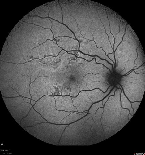 Acute Posterior Multifocal Placoid Pigment Epitheliopathy - APMPPE - Fundus Autofluorescence
 25-year-old man with one and half weeks ago he woke up with night chills.   Also around that time his joints started hurting him.  He also has headaches, although the headache at this point is not severe.  His vision has been changing for about the last week and a half.  He sees some spots in his vision and they are blurred spots.  They are not in the central vision.  
VISUAL ACUITY:  OD 20/32,  OS 20/32
