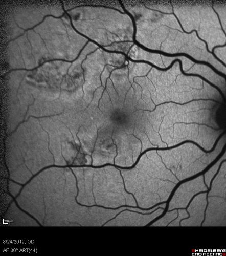 Acute Posterior Multifocal Placoid Pigment Epitheliopathy - APMPPE - Fundus Autofluorescence
 25-year-old man with one and half weeks ago he woke up with night chills.   Also around that time his joints started hurting him.  He also has headaches, although the headache at this point is not severe.  His vision has been changing for about the last week and a half.  He sees some spots in his vision and they are blurred spots.  They are not in the central vision.  
VISUAL ACUITY:  OD 20/32,  OS 20/32
