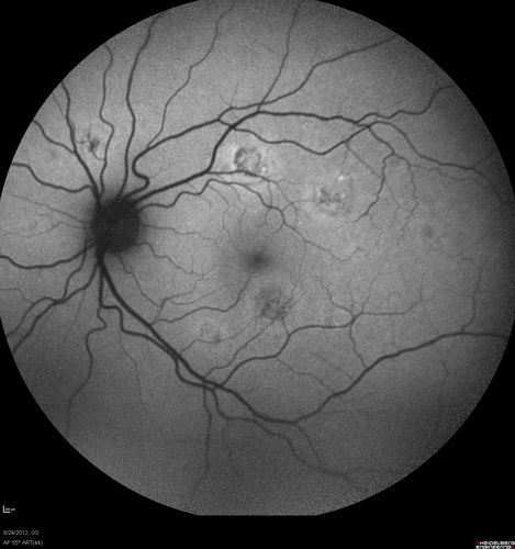 Acute Posterior Multifocal Placoid Pigment Epitheliopathy - APMPPE - Fundus Autofluorescence
 25-year-old man with one and half weeks ago he woke up with night chills.   Also around that time his joints started hurting him.  He also has headaches, although the headache at this point is not severe.  His vision has been changing for about the last week and a half.  He sees some spots in his vision and they are blurred spots.  They are not in the central vision.  
VISUAL ACUITY:  OD 20/32,  OS 20/32
