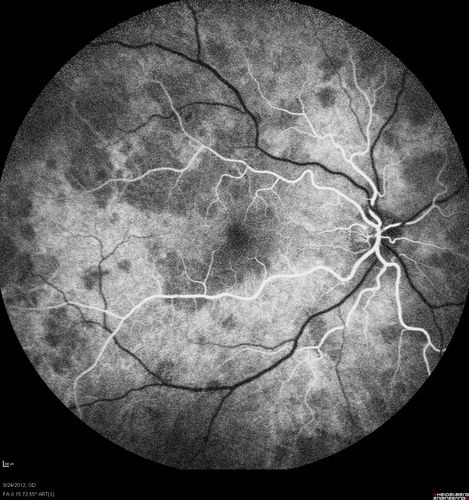 Acute Posterior Multifocal Placoid Pigment Epitheliopathy - APMPPE - Fluorescein Angiogram
 25-year-old man with one and half weeks ago he woke up with night chills.   Also around that time his joints started hurting him.  He also has headaches, although the headache at this point is not severe.  His vision has been changing for about the last week and a half.  He sees some spots in his vision and they are blurred spots.  They are not in the central vision.  
VISUAL ACUITY:  OD 20/32,  OS 20/32
