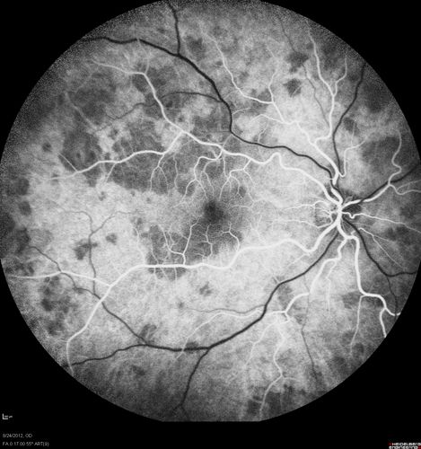 Acute Posterior Multifocal Placoid Pigment Epitheliopathy - APMPPE - Fluorescein Angiogram
 25-year-old man with one and half weeks ago he woke up with night chills.   Also around that time his joints started hurting him.  He also has headaches, although the headache at this point is not severe.  His vision has been changing for about the last week and a half.  He sees some spots in his vision and they are blurred spots.  They are not in the central vision.  
VISUAL ACUITY:  OD 20/32,  OS 20/32

