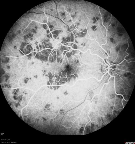 Acute Posterior Multifocal Placoid Pigment Epitheliopathy - APMPPE - Fluorescein Angiogram
 25-year-old man with one and half weeks ago he woke up with night chills.   Also around that time his joints started hurting him.  He also has headaches, although the headache at this point is not severe.  His vision has been changing for about the last week and a half.  He sees some spots in his vision and they are blurred spots.  They are not in the central vision.  
VISUAL ACUITY:  OD 20/32,  OS 20/32
