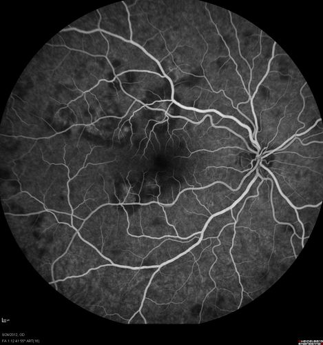 Acute Posterior Multifocal Placoid Pigment Epitheliopathy - APMPPE - Fluorescein Angiogram
 25-year-old man with one and half weeks ago he woke up with night chills.   Also around that time his joints started hurting him.  He also has headaches, although the headache at this point is not severe.  His vision has been changing for about the last week and a half.  He sees some spots in his vision and they are blurred spots.  They are not in the central vision.  
VISUAL ACUITY:  OD 20/32,  OS 20/32
