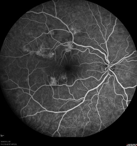 Acute Posterior Multifocal Placoid Pigment Epitheliopathy - APMPPE - Fluorescein Angiogram
 25-year-old man with one and half weeks ago he woke up with night chills.   Also around that time his joints started hurting him.  He also has headaches, although the headache at this point is not severe.  His vision has been changing for about the last week and a half.  He sees some spots in his vision and they are blurred spots.  They are not in the central vision.  
VISUAL ACUITY:  OD 20/32,  OS 20/32
