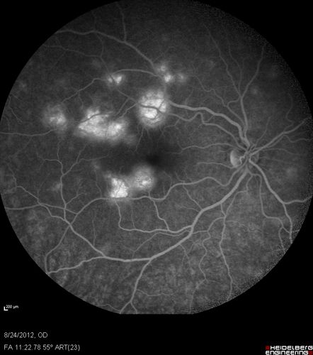Acute Posterior Multifocal Placoid Pigment Epitheliopathy - APMPPE - Fluorescein Angiogram
 25-year-old man with one and half weeks ago he woke up with night chills.   Also around that time his joints started hurting him.  He also has headaches, although the headache at this point is not severe.  His vision has been changing for about the last week and a half.  He sees some spots in his vision and they are blurred spots.  They are not in the central vision.  
VISUAL ACUITY:  OD 20/32,  OS 20/32
