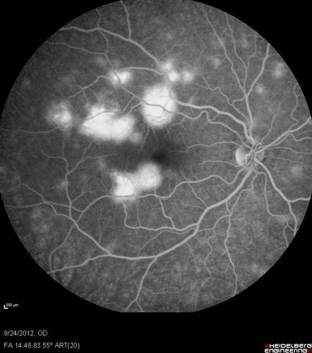 Acute Posterior Multifocal Placoid Pigment Epitheliopathy - APMPPE - Fluorescein Angiogram
 25-year-old man with one and half weeks ago he woke up with night chills.   Also around that time his joints started hurting him.  He also has headaches, although the headache at this point is not severe.  His vision has been changing for about the last week and a half.  He sees some spots in his vision and they are blurred spots.  They are not in the central vision.  
VISUAL ACUITY:  OD 20/32,  OS 20/32
