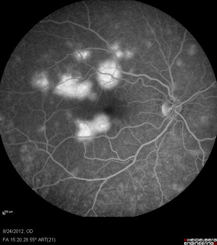 Acute Posterior Multifocal Placoid Pigment Epitheliopathy - APMPPE - Fluorescein Angiogram
 25-year-old man with one and half weeks ago he woke up with night chills.   Also around that time his joints started hurting him.  He also has headaches, although the headache at this point is not severe.  His vision has been changing for about the last week and a half.  He sees some spots in his vision and they are blurred spots.  They are not in the central vision.  
VISUAL ACUITY:  OD 20/32,  OS 20/32
