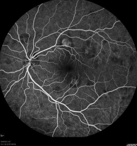 Acute Posterior Multifocal Placoid Pigment Epitheliopathy - APMPPE - Fluorescein Angiogram
 25-year-old man with one and half weeks ago he woke up with night chills.   Also around that time his joints started hurting him.  He also has headaches, although the headache at this point is not severe.  His vision has been changing for about the last week and a half.  He sees some spots in his vision and they are blurred spots.  They are not in the central vision.  
VISUAL ACUITY:  OD 20/32,  OS 20/32
