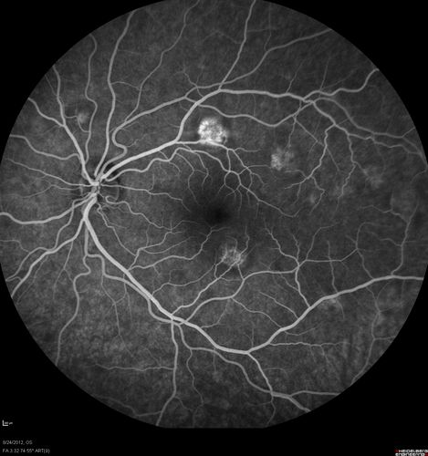 Acute Posterior Multifocal Placoid Pigment Epitheliopathy - APMPPE - Fluorescein Angiogram
 25-year-old man with one and half weeks ago he woke up with night chills.   Also around that time his joints started hurting him.  He also has headaches, although the headache at this point is not severe.  His vision has been changing for about the last week and a half.  He sees some spots in his vision and they are blurred spots.  They are not in the central vision.  
VISUAL ACUITY:  OD 20/32,  OS 20/32
