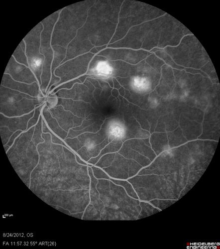Acute Posterior Multifocal Placoid Pigment Epitheliopathy - APMPPE - Fluorescein Angiogram
 25-year-old man with one and half weeks ago he woke up with night chills.   Also around that time his joints started hurting him.  He also has headaches, although the headache at this point is not severe.  His vision has been changing for about the last week and a half.  He sees some spots in his vision and they are blurred spots.  They are not in the central vision.  
VISUAL ACUITY:  OD 20/32,  OS 20/32
