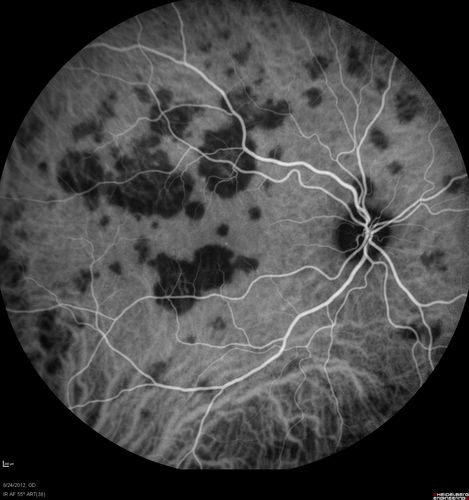 Acute Posterior Multifocal Placoid Pigment Epitheliopathy - APMPPE - Indocyanine Green Angiogram
 25-year-old man with one and half weeks ago he woke up with night chills.   Also around that time his joints started hurting him.  He also has headaches, although the headache at this point is not severe.  His vision has been changing for about the last week and a half.  He sees some spots in his vision and they are blurred spots.  They are not in the central vision.  
VISUAL ACUITY:  OD 20/32,  OS 20/32
