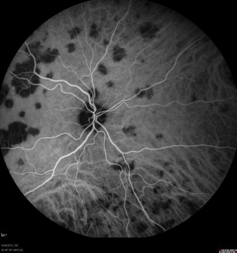 Acute Posterior Multifocal Placoid Pigment Epitheliopathy - APMPPE - Indocyanine Green Angiogram
 25-year-old man with one and half weeks ago he woke up with night chills.   Also around that time his joints started hurting him.  He also has headaches, although the headache at this point is not severe.  His vision has been changing for about the last week and a half.  He sees some spots in his vision and they are blurred spots.  They are not in the central vision.  
VISUAL ACUITY:  OD 20/32,  OS 20/32
