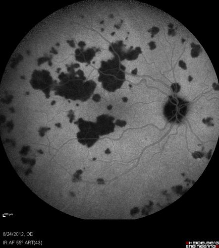 Acute Posterior Multifocal Placoid Pigment Epitheliopathy - APMPPE - Indocyanine Green Angiogram
 25-year-old man with one and half weeks ago he woke up with night chills.   Also around that time his joints started hurting him.  He also has headaches, although the headache at this point is not severe.  His vision has been changing for about the last week and a half.  He sees some spots in his vision and they are blurred spots.  They are not in the central vision.  
VISUAL ACUITY:  OD 20/32,  OS 20/32
