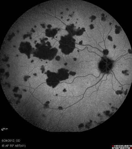 Acute Posterior Multifocal Placoid Pigment Epitheliopathy - APMPPE - Indocyanine Green Angiogram
 25-year-old man with one and half weeks ago he woke up with night chills.   Also around that time his joints started hurting him.  He also has headaches, although the headache at this point is not severe.  His vision has been changing for about the last week and a half.  He sees some spots in his vision and they are blurred spots.  They are not in the central vision.  
VISUAL ACUITY:  OD 20/32,  OS 20/32
