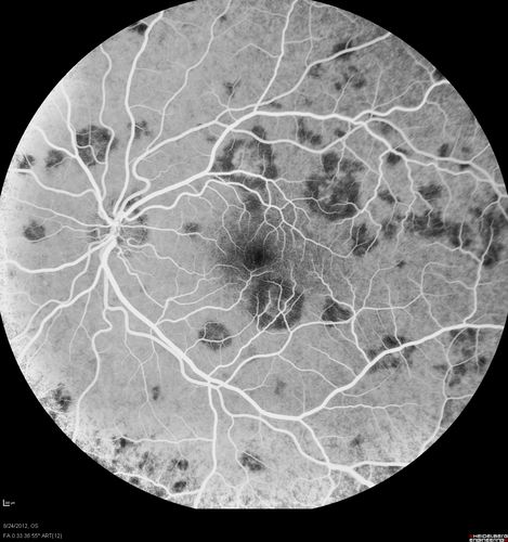 Acute Posterior Multifocal Placoid Pigment Epitheliopathy - APMPPE - Fluorescein Angiogram
 25-year-old man with one and half weeks ago he woke up with night chills.   Also around that time his joints started hurting him.  He also has headaches, although the headache at this point is not severe.  His vision has been changing for about the last week and a half.  He sees some spots in his vision and they are blurred spots.  They are not in the central vision.  
VISUAL ACUITY:  OD 20/32,  OS 20/32
