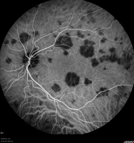 Acute Posterior Multifocal Placoid Pigment Epitheliopathy - APMPPE - Indocyanine Green Angiogram
 25-year-old man with one and half weeks ago he woke up with night chills.   Also around that time his joints started hurting him.  He also has headaches, although the headache at this point is not severe.  His vision has been changing for about the last week and a half.  He sees some spots in his vision and they are blurred spots.  They are not in the central vision.  
VISUAL ACUITY:  OD 20/32,  OS 20/32
