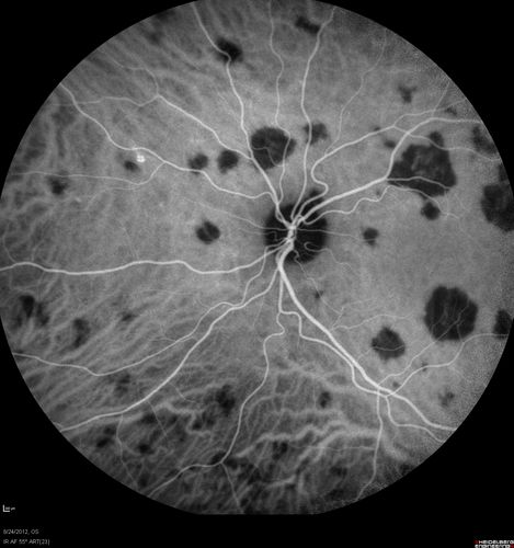 Acute Posterior Multifocal Placoid Pigment Epitheliopathy - APMPPE - Indocyanine Green Angiogram
 25-year-old man with one and half weeks ago he woke up with night chills.   Also around that time his joints started hurting him.  He also has headaches, although the headache at this point is not severe.  His vision has been changing for about the last week and a half.  He sees some spots in his vision and they are blurred spots.  They are not in the central vision.  
VISUAL ACUITY:  OD 20/32,  OS 20/32
