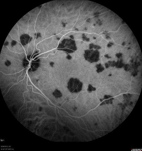 Acute Posterior Multifocal Placoid Pigment Epitheliopathy - APMPPE - Indocyanine Green Angiogram
 25-year-old man with one and half weeks ago he woke up with night chills.   Also around that time his joints started hurting him.  He also has headaches, although the headache at this point is not severe.  His vision has been changing for about the last week and a half.  He sees some spots in his vision and they are blurred spots.  They are not in the central vision.  
VISUAL ACUITY:  OD 20/32,  OS 20/32
