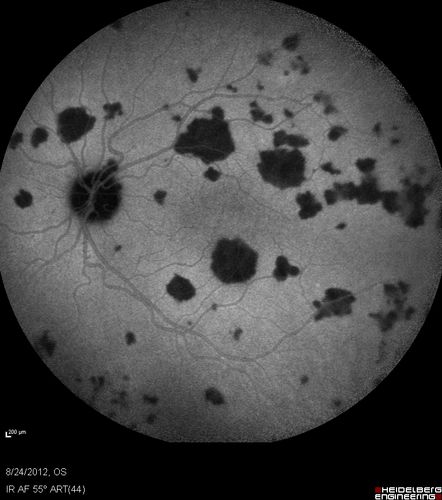 Acute Posterior Multifocal Placoid Pigment Epitheliopathy - APMPPE - Indocyanine Green Angiogram
 25-year-old man with one and half weeks ago he woke up with night chills.   Also around that time his joints started hurting him.  He also has headaches, although the headache at this point is not severe.  His vision has been changing for about the last week and a half.  He sees some spots in his vision and they are blurred spots.  They are not in the central vision.  
VISUAL ACUITY:  OD 20/32,  OS 20/32
