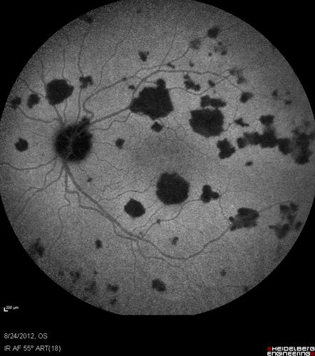 Acute Posterior Multifocal Placoid Pigment Epitheliopathy - APMPPE - Indocyanine Green Angiogram
 25-year-old man with one and half weeks ago he woke up with night chills.   Also around that time his joints started hurting him.  He also has headaches, although the headache at this point is not severe.  His vision has been changing for about the last week and a half.  He sees some spots in his vision and they are blurred spots.  They are not in the central vision.  
VISUAL ACUITY:  OD 20/32,  OS 20/32
