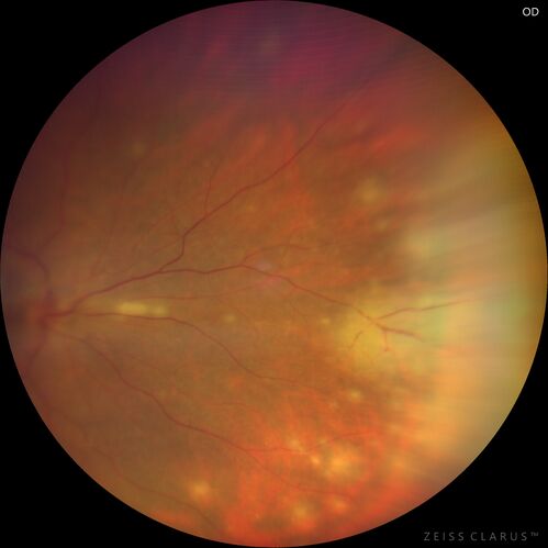 Acute retinal necrosis
67 year old female Hazy vision in the right eye for 5 days.
Medical Hx: TYPE 2 DIAB.. Hypercholesterolemia. 
Surgical Hx: COLECTOMY. 
Systemic Meds: CRESTOR 10 MG QD. METFORMIN 500 MG QD. PROLIA Q 6 MOS. SULFA 800 MG/ TRIMETHOPRIM 160 MG TID. VALCYCLOVIR 1 GM TID. PROBIOTIC QD. CENTRUM 50+ QD. ALLERGY MED QD
VA 20/40, 20/20
IOP 19, 12
SLE: Trace AC cell OD and moderate vitreous cell OD
