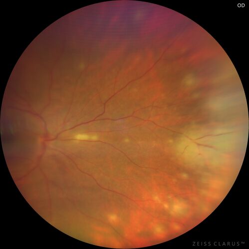 Acute retinal necrosis
67 year old female Hazy vision in the right eye for 5 days.
Medical Hx: TYPE 2 DIAB.. Hypercholesterolemia. 
Surgical Hx: COLECTOMY. 
Systemic Meds: CRESTOR 10 MG QD. METFORMIN 500 MG QD. PROLIA Q 6 MOS. SULFA 800 MG/ TRIMETHOPRIM 160 MG TID. VALCYCLOVIR 1 GM TID. PROBIOTIC QD. CENTRUM 50+ QD. ALLERGY MED QD
VA 20/40, 20/20
IOP 19, 12
SLE: Trace AC cell OD and moderate vitreous cell OD
