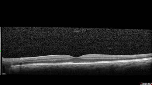 Acute retinal necrosis
67 year old female Hazy vision in the right eye for 5 days.
Medical Hx: TYPE 2 DIAB.. Hypercholesterolemia. 
Surgical Hx: COLECTOMY. 
Systemic Meds: CRESTOR 10 MG QD. METFORMIN 500 MG QD. PROLIA Q 6 MOS. SULFA 800 MG/ TRIMETHOPRIM 160 MG TID. VALCYCLOVIR 1 GM TID. PROBIOTIC QD. CENTRUM 50+ QD. ALLERGY MED QD
VA 20/40, 20/20
IOP 19, 12
SLE: Trace AC cell OD and moderate vitreous cell OD
