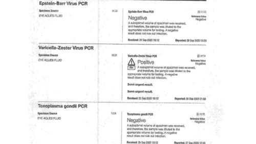 Acute retinal necrosis
67 year old female Hazy vision in the right eye for 5 days.
Medical Hx: TYPE 2 DIAB.. Hypercholesterolemia. 
Surgical Hx: COLECTOMY. 
Systemic Meds: CRESTOR 10 MG QD. METFORMIN 500 MG QD. PROLIA Q 6 MOS. SULFA 800 MG/ TRIMETHOPRIM 160 MG TID. VALCYCLOVIR 1 GM TID. PROBIOTIC QD. CENTRUM 50+ QD. ALLERGY MED QD
VA 20/40, 20/20
IOP 19, 12
SLE: Trace AC cell OD and moderate vitreous cell OD
