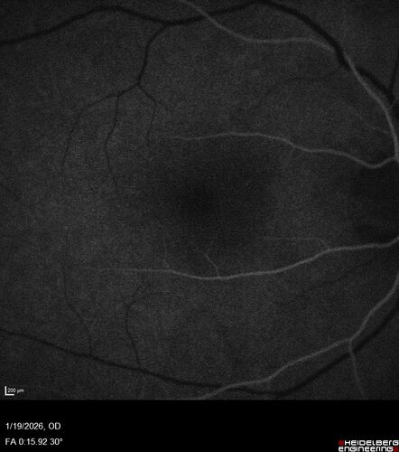 Acute Retinal Pigment Epitheliitis (Krills disease)
15 year old with sudden central vision loss in one eye.  The vision loss persisted though for at least 6 months (which may be a laser injury)
