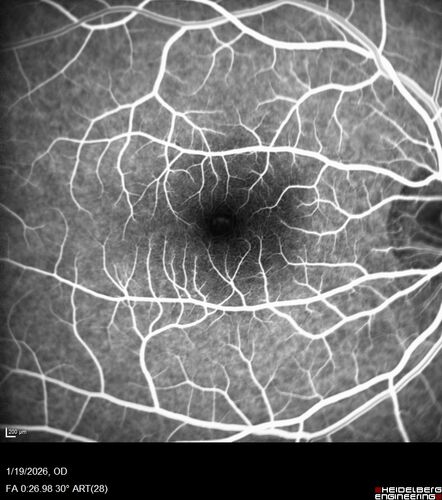 Acute Retinal Pigment Epitheliitis (Krills disease)
15 year old with sudden central vision loss in one eye.  The vision loss persisted though for at least 6 months (which may be a laser injury)
