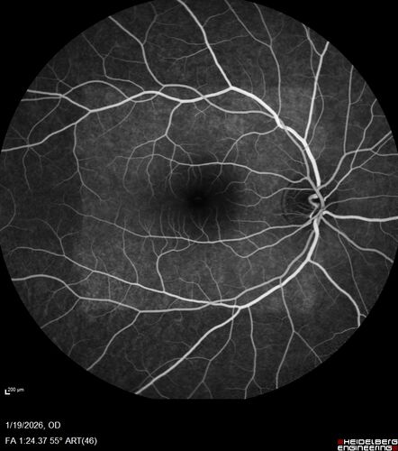 Acute Retinal Pigment Epitheliitis (Krills disease)
15 year old with sudden central vision loss in one eye.  The vision loss persisted though for at least 6 months (which may be a laser injury)
