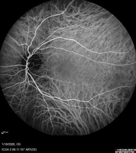 Acute Retinal Pigment Epitheliitis (Krills disease)
15 year old with sudden central vision loss in one eye.  The vision loss persisted though for at least 6 months (which may be a laser injury)
