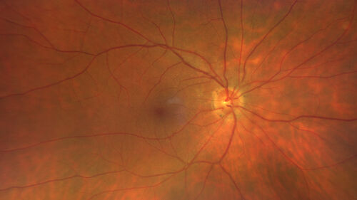 AZOOR - Inactive
Sudden vision loss in the left eye 3 years ago.  Labs for syphilis, sarcoid and TB all negative.  VA 20/32 OD, 20/80 OS
