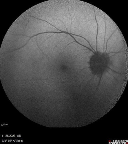 AZOOR - Inactive
Sudden vision loss in the left eye 3 years ago.  Labs for syphilis, sarcoid and TB all negative.  VA 20/32 OD, 20/80 OS
